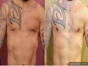 Los Angeles Gynecomastia Specialist Solve Problems For Many Men