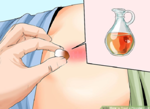 Pilonidal sinus home remedy