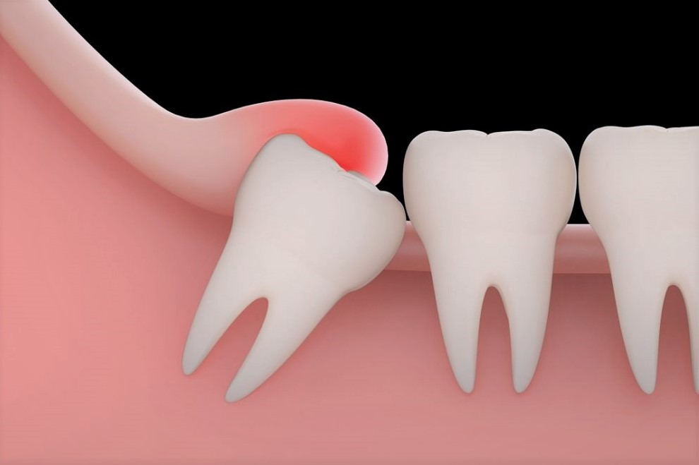 Things You Need To Know About Wisdom Teeth