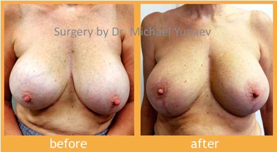 Size Down Your Breasts With Breast Reduction