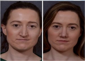 brow lift procedure