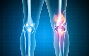 Burning Knee, Painful Knee And Normal Knee Joint, Abstract Desig