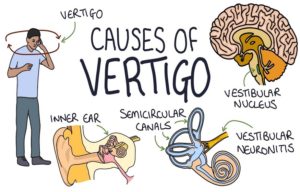 Causes And Treatments Of Vertigo
