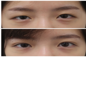 Look Younger With A Good Eyelid Surgery
