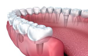 Top 3 Things You Need To Know About Getting Dental Implants
