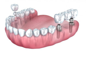 dental implants Brooklyn