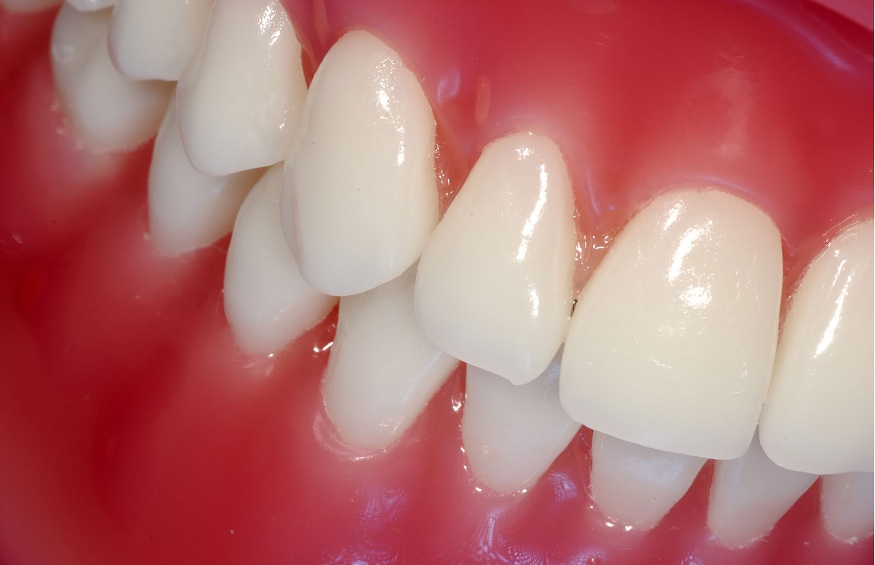 porcelain veneers cost