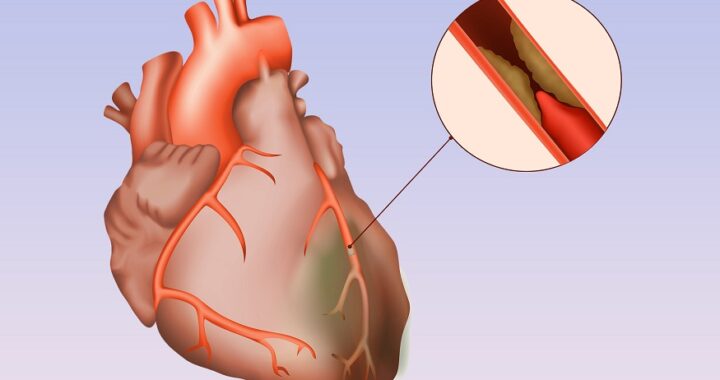 Causes of CHD