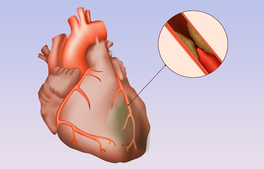 Causes of CHD