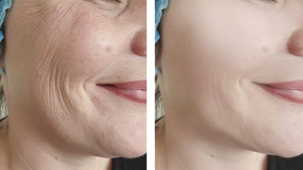 Skin Tightening