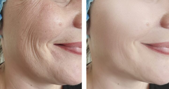 Skin Tightening