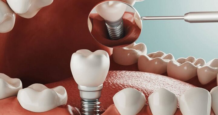 Dental Implants