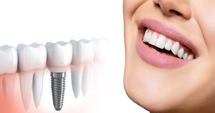 Dental Implants and What's Good About