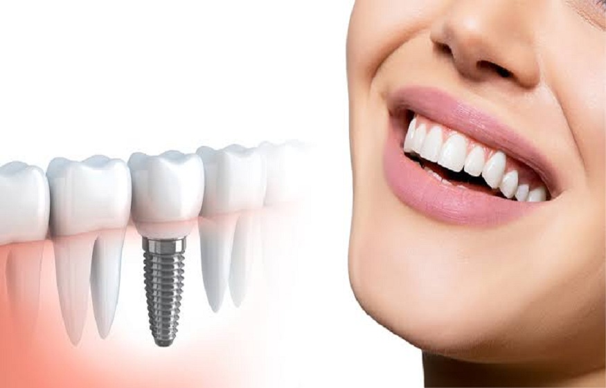 Dental Implants and What's Good About