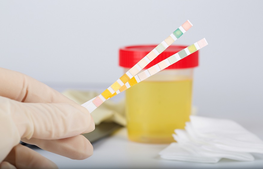 Collection cup with urine and urine test strips on a table of a lab technician.