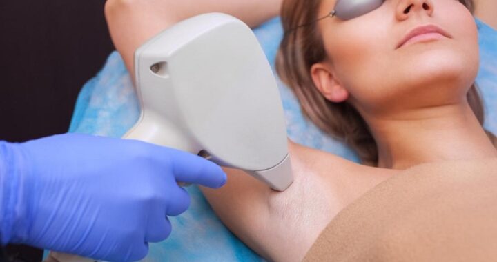 laser hair removal