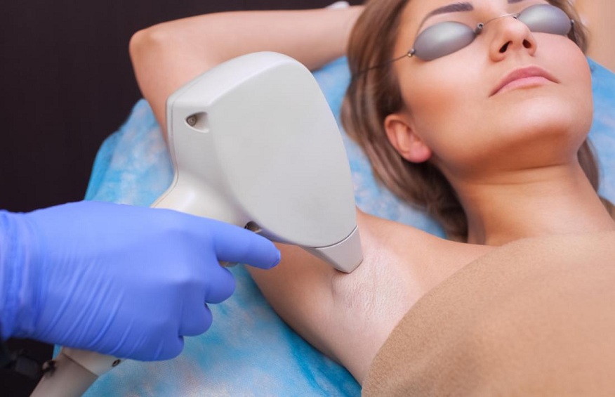 laser hair removal