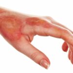 Treating Severe Burn Wounds with New Methods