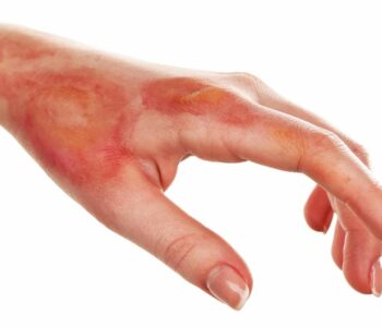 burn wounds