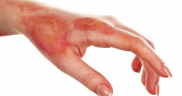 burn wounds