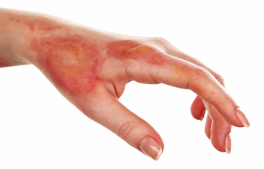 burn wounds
