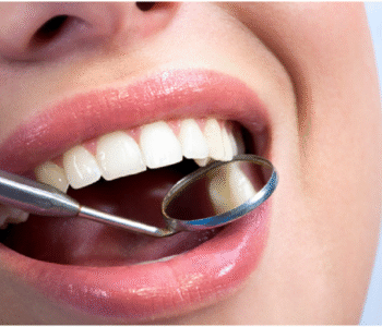 Invisalign aligners