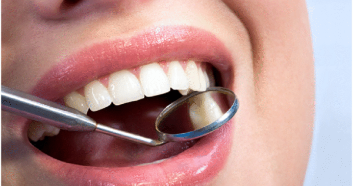 Invisalign aligners