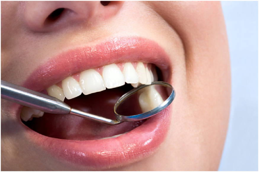 Invisalign aligners