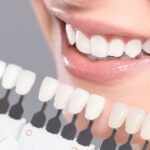 Teeth Whitening Newport Beach: What Results Can You Expect After One Session?