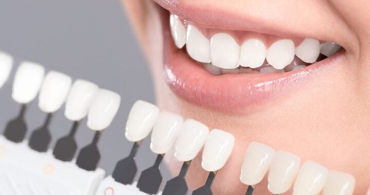 Teeth Whitening Newport Beach