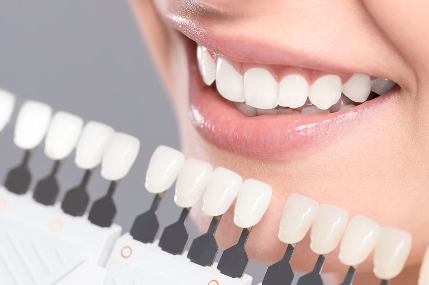 Teeth Whitening Newport Beach