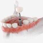 Dental Implant California: A Modern Solution for Restoring Missing Teeth
