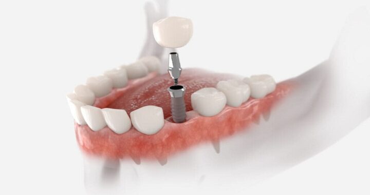 dental implant california