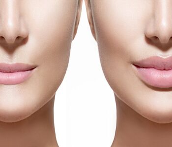 lip fillers