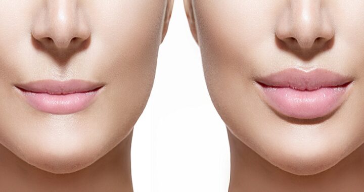 lip fillers