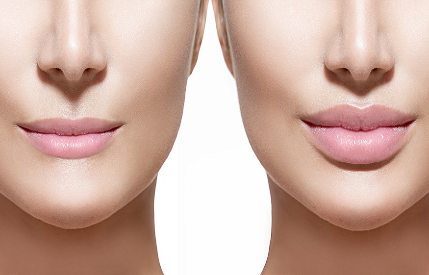 lip fillers